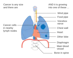 Stage IIIA lung cancer