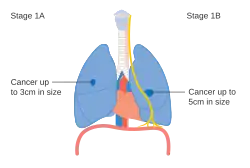 Stage IA and IB lung cancer