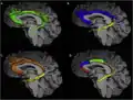 There are various ways to subdivide cingulum.[7] From figure A to D, dividing the cingulum into 1, 2, 3, and 5 components respectively.