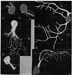 1. Pressure on globe shows only stumps of large vessels. 2. Holding the breath causes similar effect; also 3. Holding the head low. 4. Pressure on opposite eye widens arteries and still more veins, 5. Pressure on the carotid produces no definite effect. 6. Looking thru red glass brings out finer vessels.