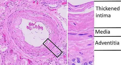 Histopathology of arcuate artery nephrosclerosis, seen as a thickened intima with an onion skin-like architecture. It is presumably a manifestation of hypertensive kidney disease.