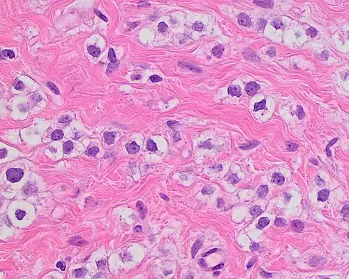 Invasive lobular carcinoma with moderate nuclear pleomorphism.