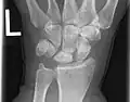 Left hand x-ray with Kienbock's Disease showing 4&nbsp;mm negative ulnar variance and Kienbock's Disease Stage IIIB