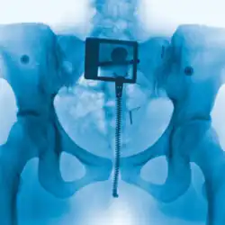 A blue-tinted x-ray of a pelvis. A belt buckle, pants zipper, pants rivets and an IUD can be seen on the x-ray.
