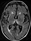 Axial MRI FLAIR image showing hyperintense signal in the mesial dorsal thalami, a common finding in Wernicke encephalopathy. This patient was nearly in coma when IV thiamine was started, he responded moderately well but was left with some Korsakoff type deficits.