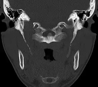 CT scan, coronal section showing bilateral extended styloid process and stylohyoid ligament ossification (incidental finding)
