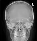 Paranasal sinuses radiograph (occipitofrontal)