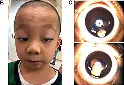 Photo of the patient with Baraitser–Winter syndrome with highly arched eyebrow, anteverted nares, long philtrum, ptosis, thin upper lip, retrognathia, epicanthal fold, hypertelorism, and wide nasal bridge. In picture C bilateral coloboma can also be seen.