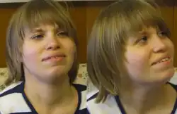 A photo showing person with 9q34.3 deletion syndrome.