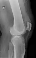 Quadriceps tendon rupture in plain X-ray: Incomplete rupture with haematoma in tendon.