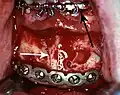 Rigid internal fixation of parasymphysis fracture of the mandible. White arrow marks fracture, black arrow marks arch bar on lower teeth