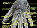 Flexor digiti minimi brevis muscle