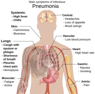Illustration of pneumonia symptoms on a human body
