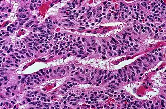 Trabecular, elongated (rod-shaped) groups of cells.