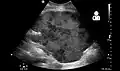 Postoperative bleeding following kidney transplant as seen on ultrasound[86]