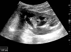 Figure 16. Hydronephrosis with dilated anechoic pelvis and calyces, along with cortical atrophy. The width of a calyx is measured on the US image in the longitudinal scan plane, and illustrated by '+' and a dashed line.[1]