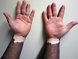 Non-segmental vitiligo on dark skin