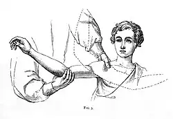 An example of On-bone setting by W.P. Hood